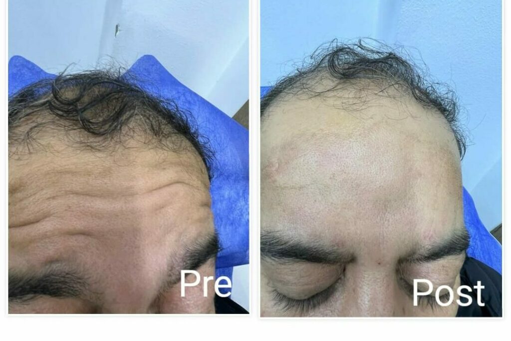 Before and after Botox forehead line removal at the best Botox clinic in Hurghada